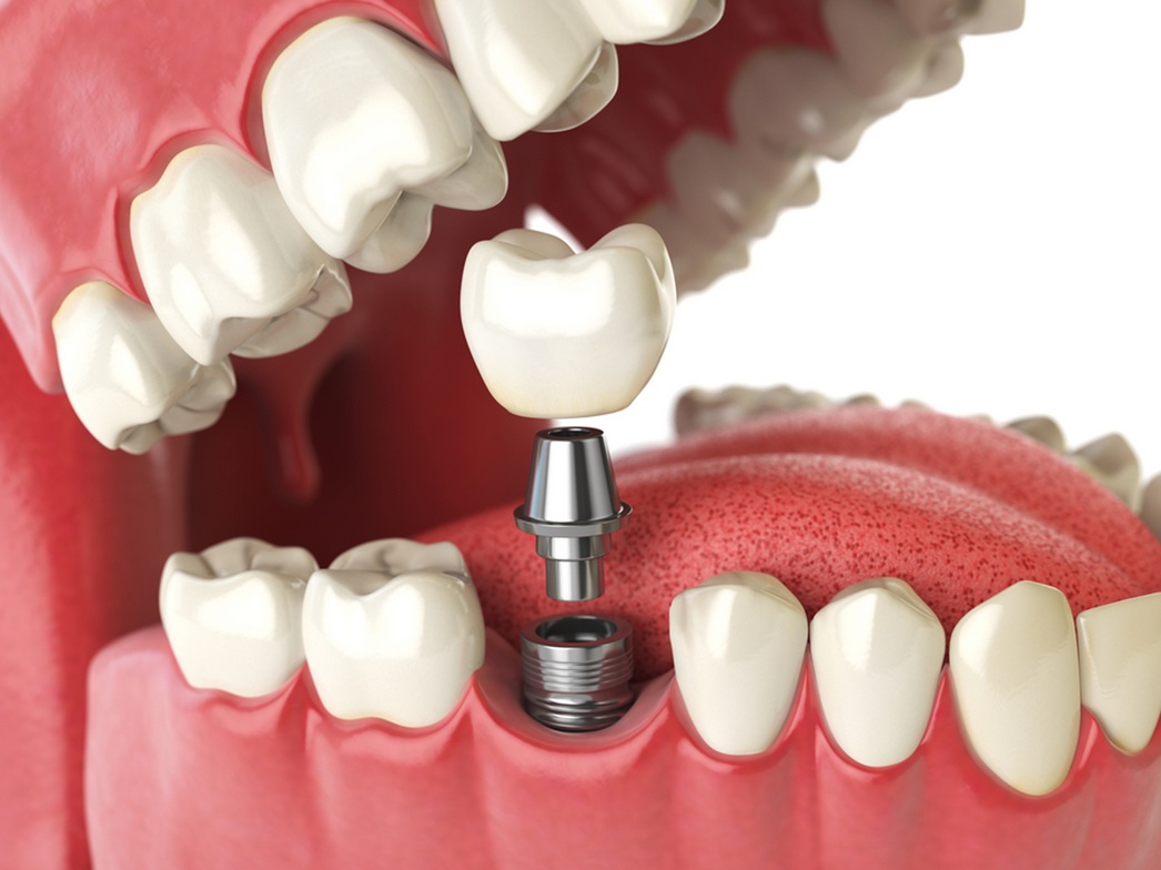 dental implants in Chaparral