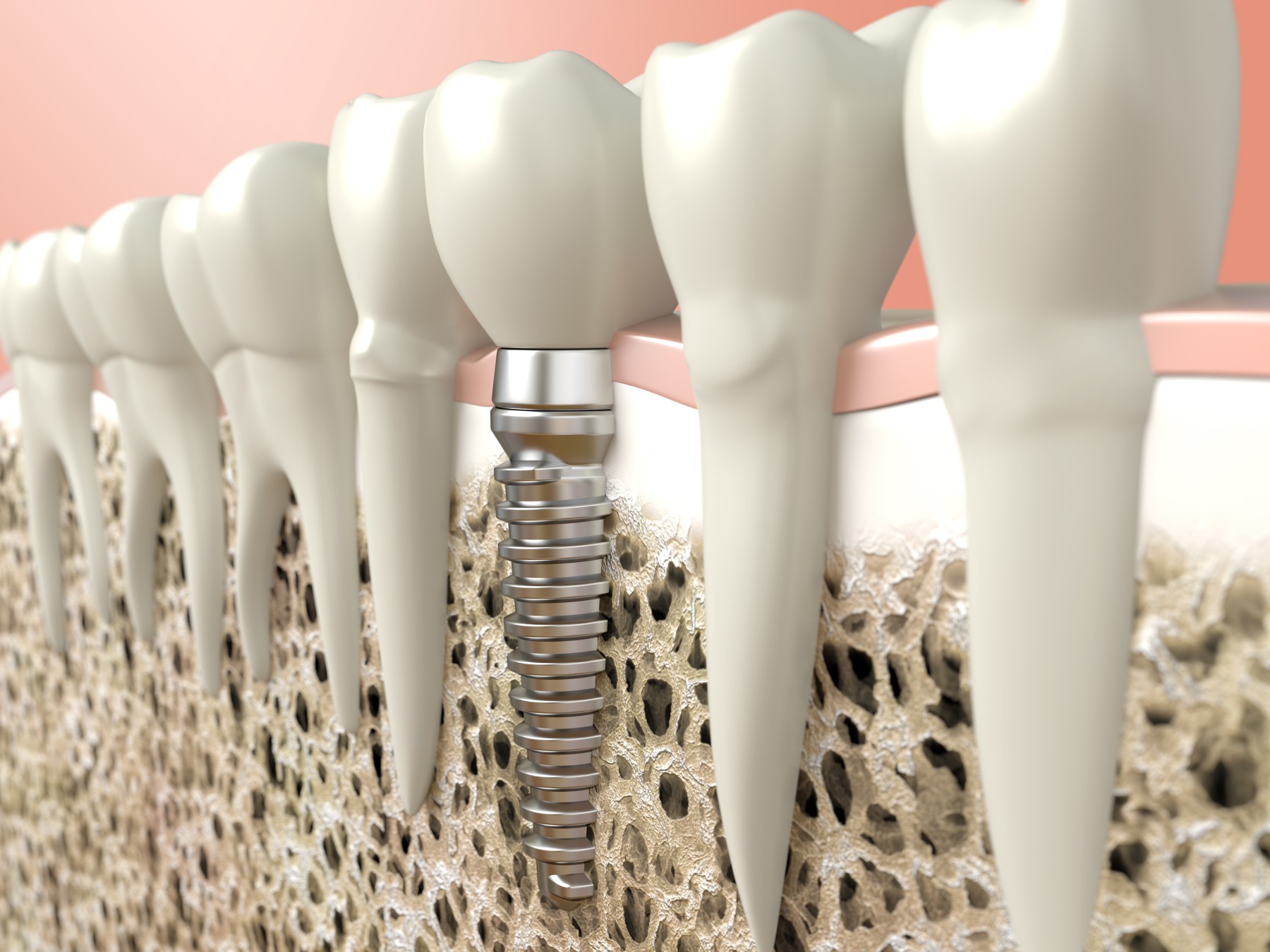 are dental implants right for you.