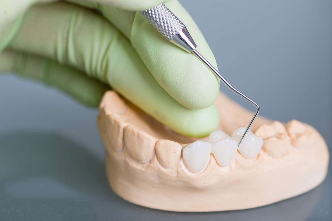 dental bridges and crowns in Chaparral