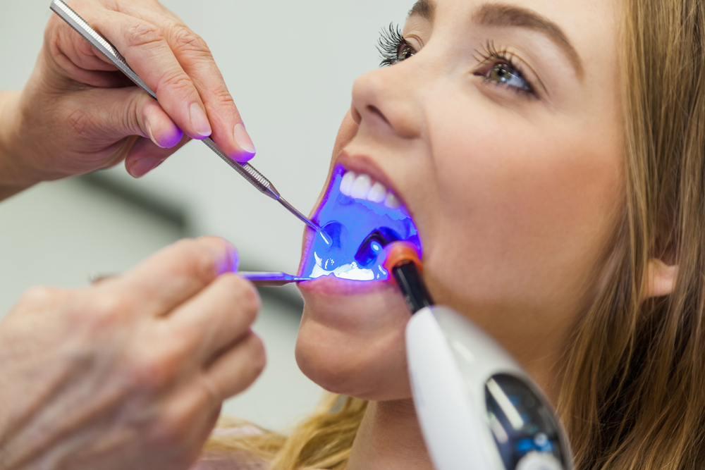 is it better to have tooth-coloured fillings than metal fillings